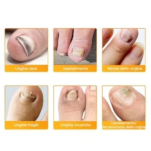 PARCHES PARA HONGOS EN LAS UÑAS - PAGA 1 LLEVA 2