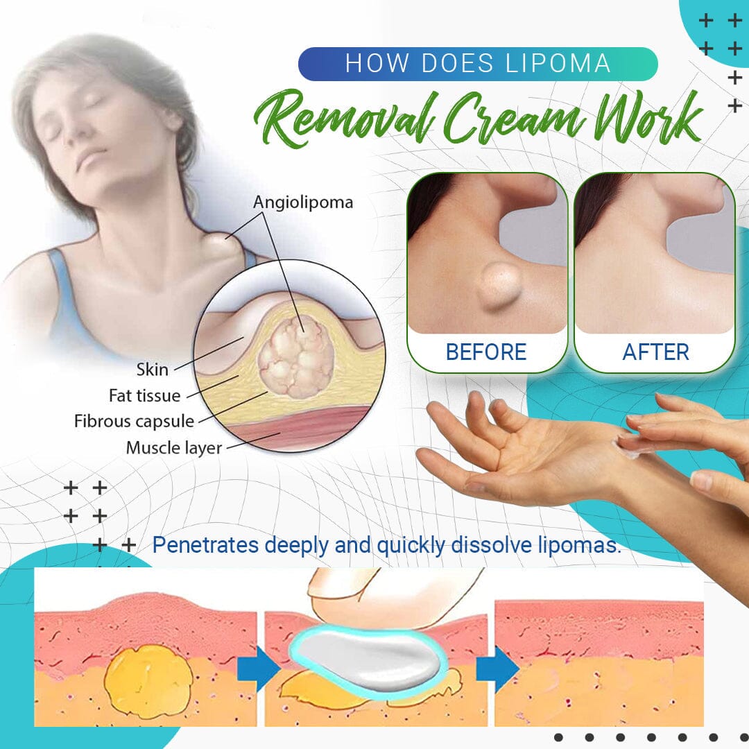 Crema para eliminar lipomas LumpFree