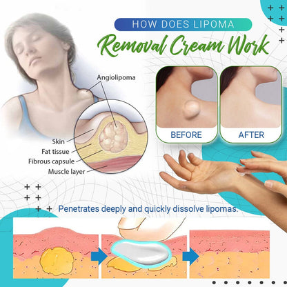 Crema para eliminar lipomas LumpFree