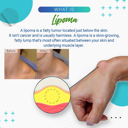 Crema para eliminar lipomas LumpFree